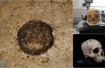 Historic Egyptians Tried to Surgically Deal with Most cancers, Research Finds