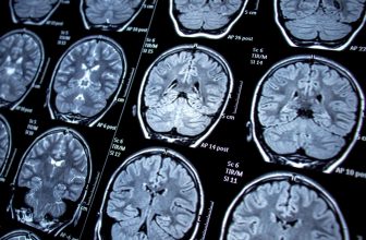 New Research Hyperlinks Shingles to Cognitive Decline